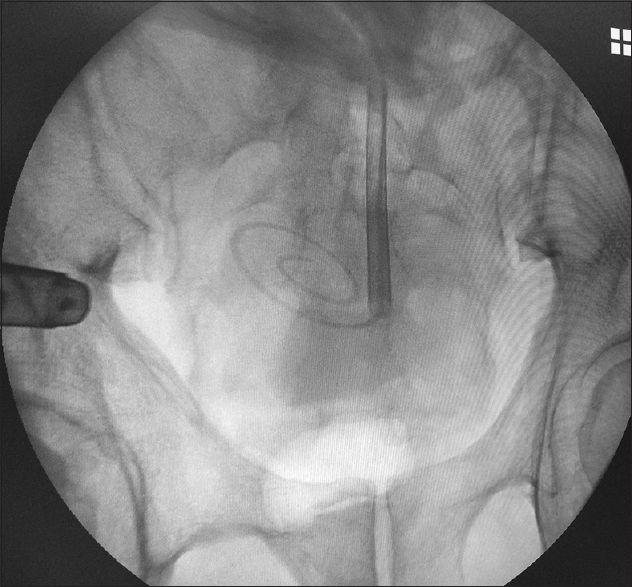 Fluoroscopic image showing appropriate delivery and placement of the coiled-tip peritoneal dialysis catheter