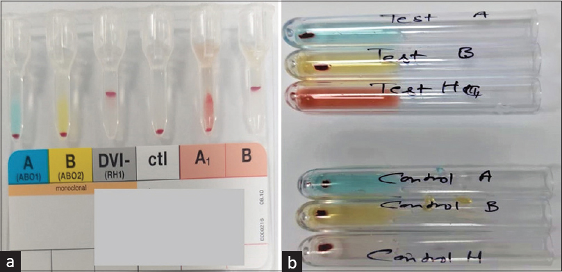 (a and b) Part A suggests blood group of donor falsely as O-positive on column agglutination technique. Part B suggests that the donor is secreting H substance in her saliva