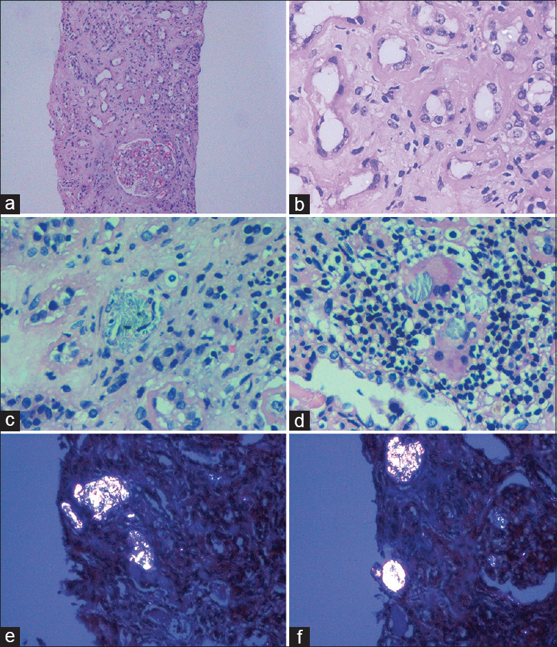 Light microscopy examination of the kidney biopsy specimen. Low-power and high-power views showing evidence of acute tubular injury (a, ×10 and b, ×40), with calcium oxalate crystals in the lumina of some tubules (c, ×40). Crystals are also seen within multinucleated giant cells, which are surrounded by numerous lymphocytes (d, ×40). Sections examined under polarized light showing several birefringent calcium oxalate crystals in the tubular lumina (e and f, ×20) (hematoxylin and eosin stain)