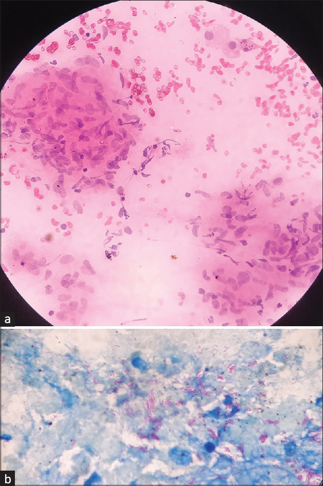 (a) Epithelioid cell granuloma eliciting granulomatous inflammation (HE stain- 400×). (b) Beaded acid-fast bacilli consistent with Mycobacterium tuberculosis (20% ZN stain- 1000×). HE = hematoxylin and eosin, ZN = Ziehl–Neelsen