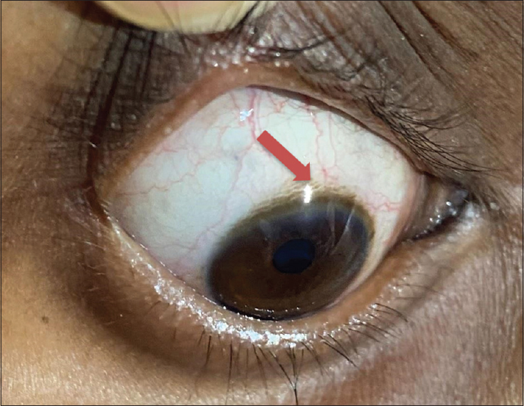 Arrow shows Kayser–Fleischer rings seen at the limbus of the cornea