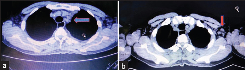 Multiple enlarged discrete lymph node in (a) mediastinum and (b) left axilla