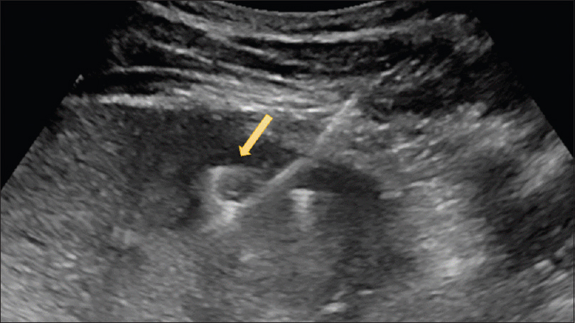 Ultrasound-guided percutaneous drainage showing the pigtail catheter advanced into the hypoechoic portion of the right renal abscess (arrow)