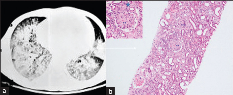 (a) Computed tomography scan of chest showing bilateral diffuse air space opacities with peripheral sparing suggestive of diffuse alveolar hemorrhage. (b) Photomicrograph shows different stages of glomerular thrombotic microangiopathy – acute stage (*mesangiolyses), subacute (**fibrillated mesangium), and chronic (***collapse) along with vascular subacute TMA (star, inset) (hematoxylin and eosin with 20× magnification, inset 40×