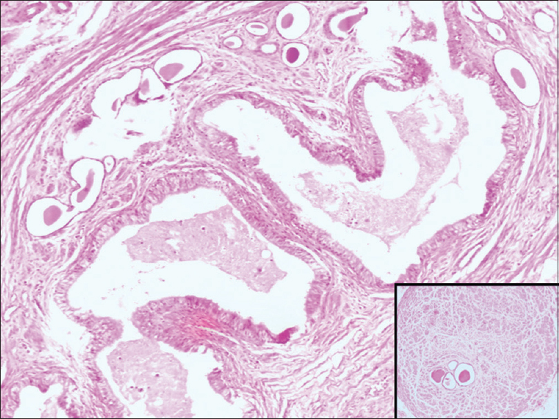 Section shows dilated tubular structures with tall columnar cells with cilia resembling epididymis and lobules of tubular structures lined by a single layer of cells filled with colloid material. (H&E 100×) Inset showing sections from the ureter with muscular hypertrophy and tubular structures. (H&E 40×)