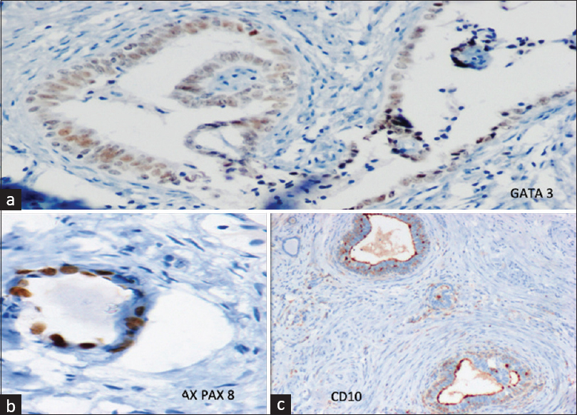 (a) IHC for GATA 3 showing nuclear positivity in the epithelia of epididymis-like tubular structures. (b) IHC for PAX8 shows nuclear positivity in the epithelia of a tubular structure. (c) IHC for CD10 showing luminal positivity in the epithelia of an epididymis-like tubular structure