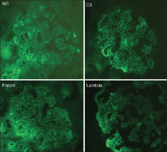 Immunofluorescence findings: mesangial immune deposits of IgG, C3, kappa, and lambda