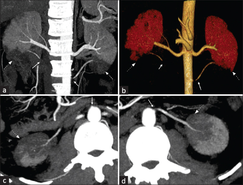 Images of CECT (Contrast-enhanced Computed Tomography) abdomen in the arterial phase of a 38-year-old-male patient with a history of blunt trauma abdomen showing bilateral aberrant renal artery thrombosis ((white solid arrows) just beyond the aberrant renal arteries’s’ origins from the aorta and segmental infarcts (white dashed arrows) in the lower poles of bilateral kidneys with normal main renal arteries. (a) MIP (Maximun Intensity Projection) coronal curved reformatted image. (b) Volume-rendered image. (c) MIP axial curved reformatted image along the axis of the right aberrant renal artery. (d) MIP axial curved reformatted image along the axis of the left aberrant renal artery