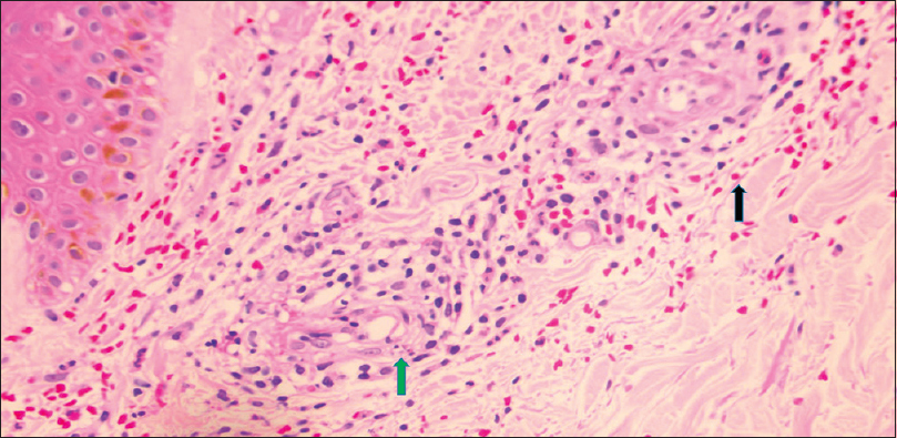 Hematoxylin and eosin (H&E) microphotograph. H&E microphotograph shows skin with unremarkable epidermis (left upper corner) superficial dermal blood vessels with significant neutrophilic, lymphocytic perivascular infiltrate associated with leucocytoclasis (green arrow) and RBC exocytosis (black arrow. Hematoxylin & Eosin stained section (40X).