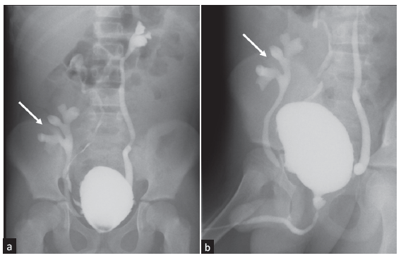 Spot images (a-b) of micturating cystourethrography show grade II vesicoureteral reflux on the right side and grade III vesicoureteral reflux on the left side. Grade III vesicoureteral reflux is seen in the transplanted kidney in the right iliac fossa (arrows in a and b).