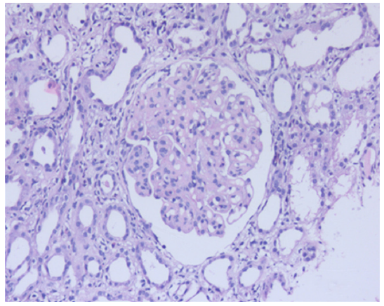 H&E sections show glomerulus with uniform thickening of glomerular basement membrane with mild mesangial proliferation [40x], H&E: Hematoxylin & Eosin.