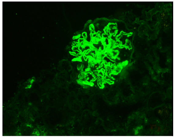IgG immunofluorescence positive in the glomeruli [intensity-3+], IgG: Immunoglobulin G.