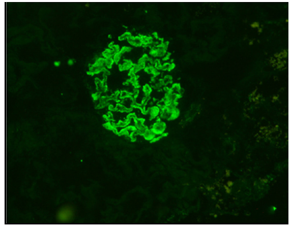 C1q immunofluorescence positive in the glomeruli [intensity-2+].