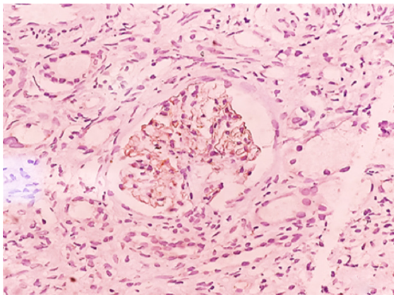 NELL-1 immunohistochemistry positive in the glomeruli [intensity-3+], NELL-1: Nerve epidermal growth factor like protein.