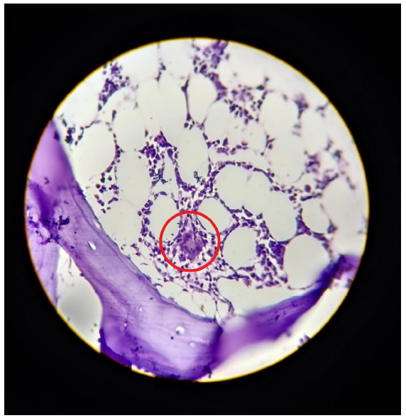 Bone marrow biopsy showing hypocellularity with small granuloma (within red circle) composed of epithelioid cells and Langhan giant cells with spotty necrosis.