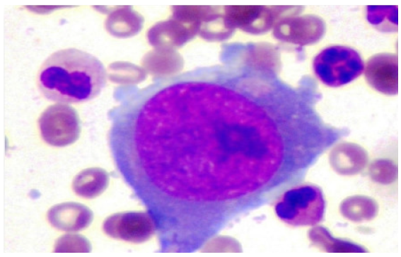 Bone marrow picture of patients with parvovirus B19 infection.