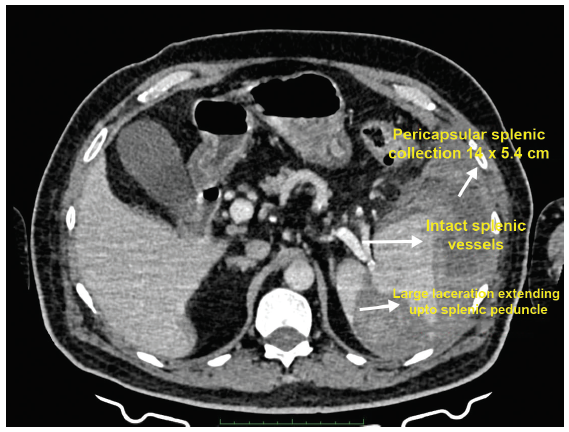 Large laceration extending up to the splenic peduncle. Distorted spleen with heterogenous hyperdense pericapsular splenic collection (14 cm × 5.4 cm).