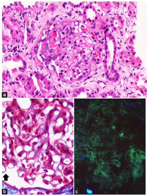 (a and b) Glomerulus showing segmental fibrinoid necrosis and cellular crescent formation (Haematoxylin and Eosin stain) with concomitant segments of capillary wall thickening and subepithelial fuschinophilic deposits (bold black arrow in b), Masson trichrome stain), original magnifications X40. (c) Immunolfuorescence microscopy depicting global fine granular (3+ intensity staining for IgG), original magnifications X40