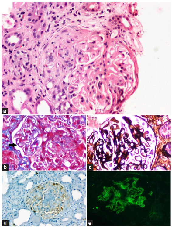 (a) Glomerulus showing circumferential fibro cellular crescent formation, Haematoxylin and Eosin stain, (b) concomitant segments of capillary wall thickening and subepithelial fuschinophilic deposits (bold black arrow) Masson trichrome stain, (c) Segments of structural capillary wall abnormalities with spike formation, Jones methenamine silver stain, (d) PLA2R immunohistochemistry shows faint non diagnostic staining of podocytes(interpreted to be negative), original magnifications X40. (e) Immunofluorescence microscopy depicting global fine granular (3+intensity staining for IgG), original magnifications X40. PLA2R: phospholipase A2 receptor.