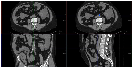 CT scan image of aortitis. CT: computed tomography.