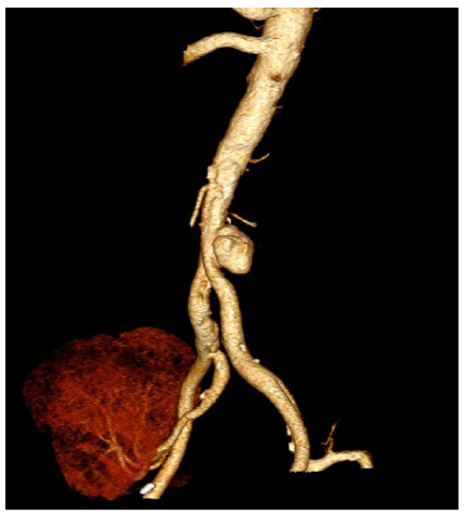 CT scan image showing aortic aneurysm. CT: computed tomography.