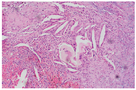 H&E staining of excised aortic wall. H&E: hematoxylin and eosin.