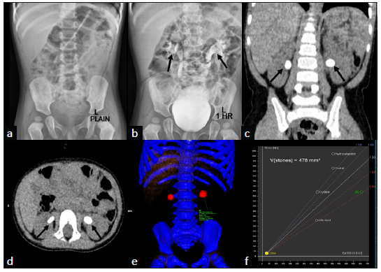 Plain radiograph (a) shows no radiopaque calculi in the renal fossae on either side, while post-contrast injection 1-h spot (b) shows two radiolucent filling defects in the bilateral renal pelvis (black arrows) with mild hydronephrosis. Coronal (c) and axial (d) multiplanar reformatted images of dual-energy computed tomography (DECT) scan show bilateral renal calculi (black arrows in c and d) with mild hydronephrosis. Color overlay image (e) of DECT scan shows bilateral renal calculi, which are color-coded red. On dual-energy radiograph evaluation (f), left renal calculus (region of interest shown in e) is seen to have a uric acid composition (green circle in f).