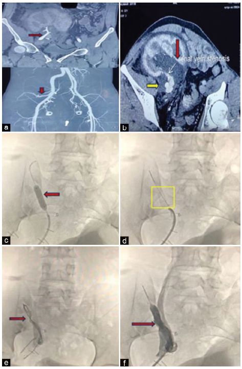 (a) Normal contrast enhancement of the graft renal artery with no evidence of stenosis. Red arrows show normal contrast enhancement of graft renal artery with no evidence of stenosis (b) Graft renal vein stenosis with hydronephrosis (red arrow) and peripelvic fluid collection (yellow arrow). White arrow shows graft renal vein stenosis. (c) Balloon angioplasty (red arrow) being performed in the stenosed renal vein. (d) Simultaneous renal vein stent placement (yellow square). (e) Compromised flow in the stenosed graft renal vein (red arrow). (f) Significantly improved flow in graft renal vein post-stenting (red arrow).