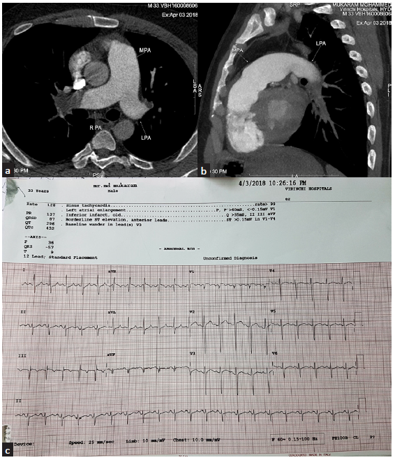 (a) CT pulmonary angiogram – axial section at the level of pulmonary artery bifurcation reveals dilated pulmonary artery with large hypodense occlusive thrombus at right distal pulmonary artery and at the origin of left upper lobe artery. (b) Sagittal section reveals complete obstruction of left distal pulmonary artery with thrombus extending into lower lobar and segmental artery. (c) ECG – typical S1, Q3, T3 suggestive of PTE. CT = computerised tomography, ECG = electrocardiogram, S1 Q3 T3 = deep S wave in lead 1 Q wave in lead 3, inverted T in led 3, MPA = main pulmonary artery, RPA = right pulmonary artery, LPA = left pulmonary artery.