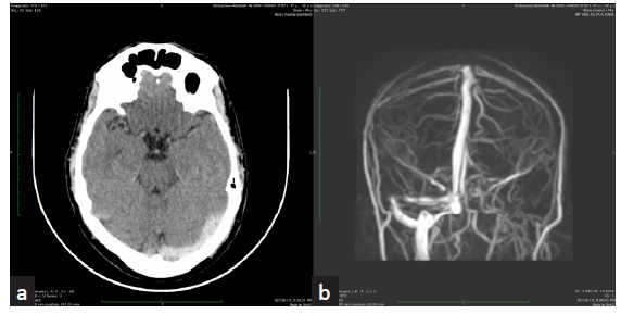 (a) Non-contrast axial CT of brain reveals hyperdensity of left transverse sinus suspicious of thrombosis. (b) Phase-contrast 3D MRI coronal MIP shows absence of flow signal in left transverse sinus. Suggestive of thrombosis. CT - computer tomography, MRI- magnetic resonance imaging, MIP - maximum intensity projection.