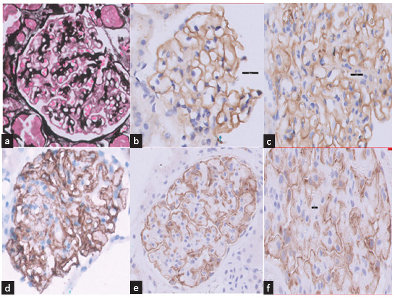 (a) Glomerulus showing irregularly thickened capillary walls with bubbly appearance consistent with MN (Jones silver stain x400). (b) Weak positivity (1+) for IgG on glomerular capillary walls (IHC IgG x800). (c) Moderate positivity (2+) for C3 on glomerular capillary walls (IHC C3 x800). (d) Strong positivity (3+) for C4d on glomerular capillary walls and few podocytes (IHC C4d x800). (e) Diffuse strong and granular staining on capillary walls with PLA2R immunostain (IHC PLA2R x400). (f) Strong granular positivity (3+) for PLA2R on glomerular capillary walls (IHC PLA2R x1000). PLA2R: Phospholipase A2 Receptor Antibody, IHC: Immonohistochemistry.