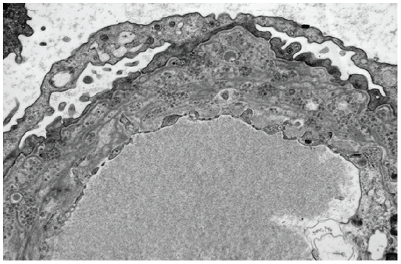 Electron microscopic image showing characteristic microspherical particles entrapped within a lamellated glomerular basement membrane (TEM uranyl acetate stain x3000).