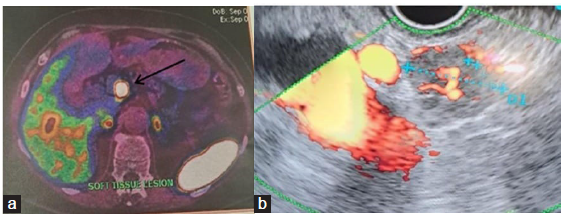 (a) DOTANOC scan showing pancreas tumor (black arrow). (b) Endoscopic ultrasound doppler and biopsy.