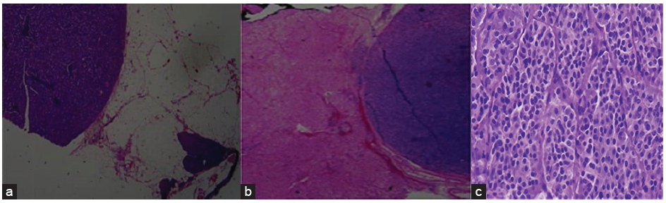 The histopathology of the tumor (a) showing native pancreatic tissue with NET, (b) liver parenchyma with metastatic pancreatic NET (H&E 2× magnification), (c) well-differentiated pancreatic NET. (H&E 40 x magnification). H&E: Hematoxylin and eosin, NET: neuroendocrine tumor.