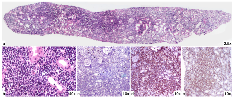 Renal Biopsy (a) H&E (2.5X magnification): One core of renal tissue showing interstitium diffusely infiltrated by atypical small round blue cells. (b) H&E High power (40X magnification) showing the atypical cells to be monomorphic lymphoid cells with scant amount of cytoplasm and irregular large hyperchromatic nucleus. The cells are 2.5 to 3 times size of small mature lymphocytes and have irregular nuclear contours. (c) CD20 (10X magnification) The atypical lymphoid cells are negative for CD20. (d) CD3 (10X magnification) The atypical lymphoid cells are strongly positive for CD3. (e) TdT (10X magnification) The atypical lymphoid cells are positive for terminal deoxynucleotidyl transferase (TdT). H&E: Hematoxylin & Eosin.