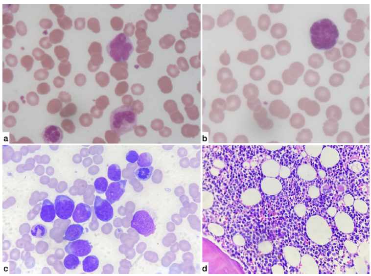 (a & b) Peripheral smear (100X magnification): Atypical cells having 2.5 to three times the size of small mature lymphocytes with scant to moderate cytoplasm, highly irregular nuclear membranes and opened out chromatin with many showing prominent nucleoli. (c) Bone marrow Aspirate (100X magnification): Blasts with scant to moderate bluish cytoplasm and irregular opened out nucleus with 1-2 prominent nucleoli. (d) Bone marrow Trephine (40X magnification): Shows sheets of atypical monomorphic lymphoid cells irregular nuclear contours and prominent nucleoli.