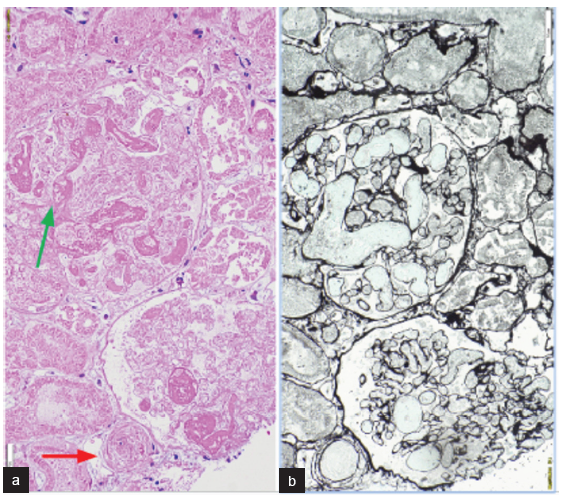 Kidney biopsy findings. Complete cortical infarct with outline of glomerular vessels defined on (a) PAS and (b) Silver methenamine with large fibrin thrombi in glomerular lumen (green arrow in a). Afferent arteriole also shows fibrin thrombus (red arrow in a) [Periodic Acid Schiff (PAS) and silver methenamine 20x].