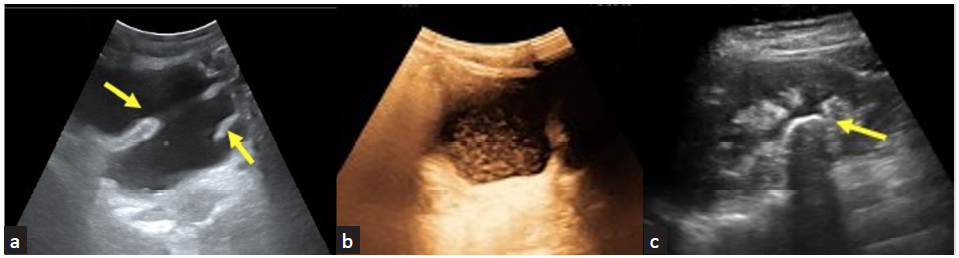 (a) Anechoic clear urine in a renal recipient with neurogenic bladder. Trabeculated walls of the bladder seen (yellow arrows); (b) echogenic contents in the urine in cystitis; (c) curvilinear renal pelvic calculus (yellow arrow).