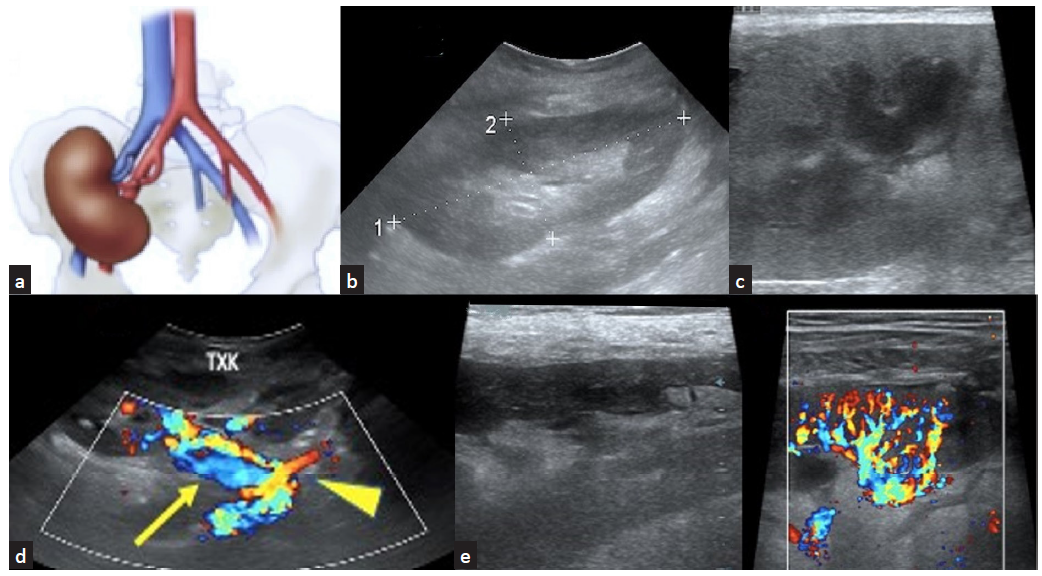 (a) Graft kidney placed in RIF depicting the nature of anastomosis of the renal artery and vein; (b) normal graft kidney in RIF; (c) renal cortex and medulla; (d) normal graft vessels (yellow arrow) including anastomotic site (yellow arrowhead) are visualized well; (e) graft vascularity including arcuate vessels seen on color Doppler study.