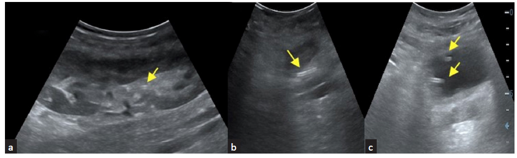 Double J (DJ) stent (yellow arrows) seen in the (a) graft renal pelvis, (b) ureter and in the (c) urinary bladder.