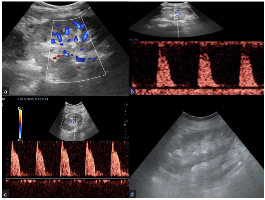 (a) Acute tubular injury in an allograft with prolonged ischemia time with color Doppler images show sparse vascularity; (b) spectral Doppler shows increased vascular resistance; (c) color Doppler imaging shows increased vascular resistance seen in a graft kidney with acute cell-mediated rejection; (d) chronic allograft nephropathy shows cortical thinning with increased echogenicity of the cortex.