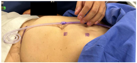 Location of the pubic symphysis, utilizing a Tenckhoff catheter as a guide for marking.