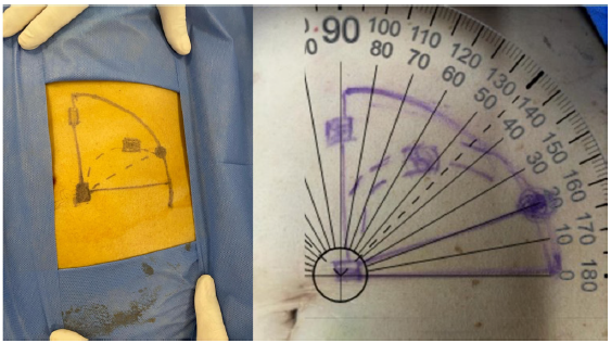 Catheter curve marking.