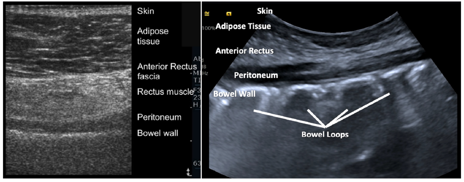 Pre-procedure ultrasonographic tracking.