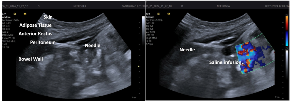 Visualization and verification of the catheter needle.