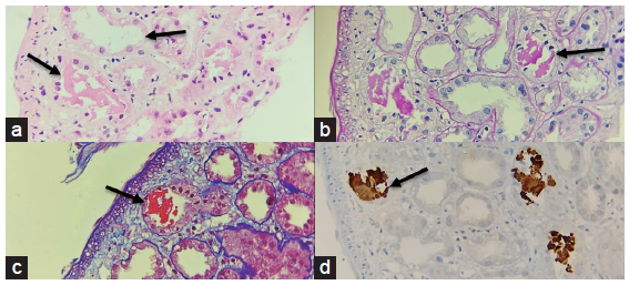 A panel of photomicrographs (400x) of the renal biopsy with black arrows depicting acute tubular injury with ropy and globular casts which are eosinophilic (a) H/E stain, (b) weakly PAS positive (PAS stain) (c) fuchsinophilic (MT stain) (d) Immunohistochemistry for Myoglobin showed positivity in these casts MT: Masson’s Trichrome.