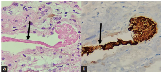 A panel of photomicrographs (400x) of the renal biopsy with black arrows showing the (a) ropy and granular cast which is eosinophilic (H/E stain) (b) Immunohistochemistry for Myoglobin showed positivity in the cast.