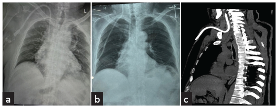 (a) Chest X ray showing normal position of TCC after insertion. (b) Chest X ray Showing cephalad migrated TCC. (c) CT Showing cephalad migration of TCC into IJV with tip lying at C2 vertebral level. TCC: Tunneled cuffed catheter, CT: Computerised tomography, IJV: Internal jugular vein, C2: Second cervical vertebra.