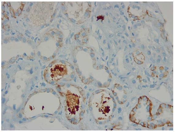 Kidney biopsy showing pigmented granular cast staining positively for myoglobin and negatively for hemoglobin.