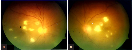 Fundus findings of patient 4 with fungal endophthalmitis (a) Right eye (b) Left eye. The fundus findings showing multifocal white retinitis lesions in both eyes with foveal involvement in right eye (black arrow in a).